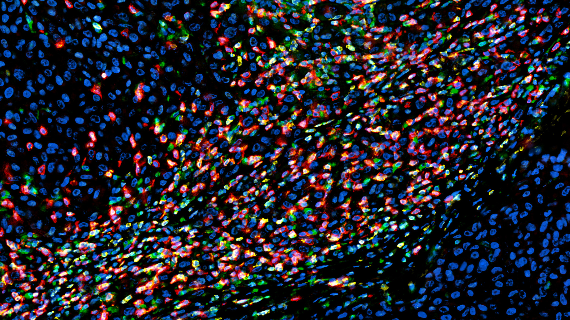 Mikroskopische Aufnahme von humanem Melanomgewebe (Hautkrebs). Bunt eingefärbt sind eindringende Immunzellen, blau erscheinen Tumorzellen.