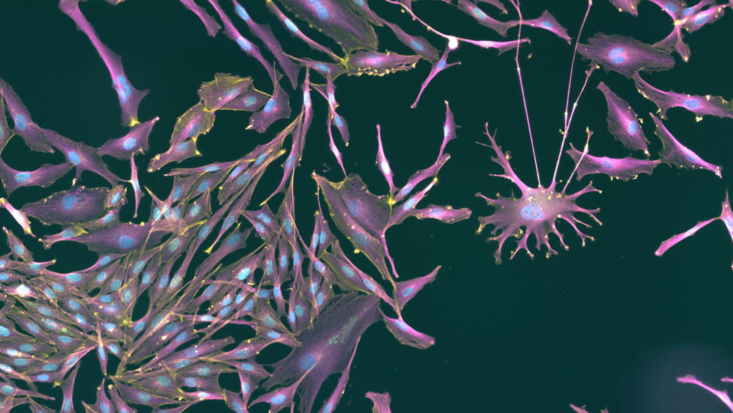 research image melanoma research